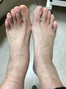 ねんざ8日目