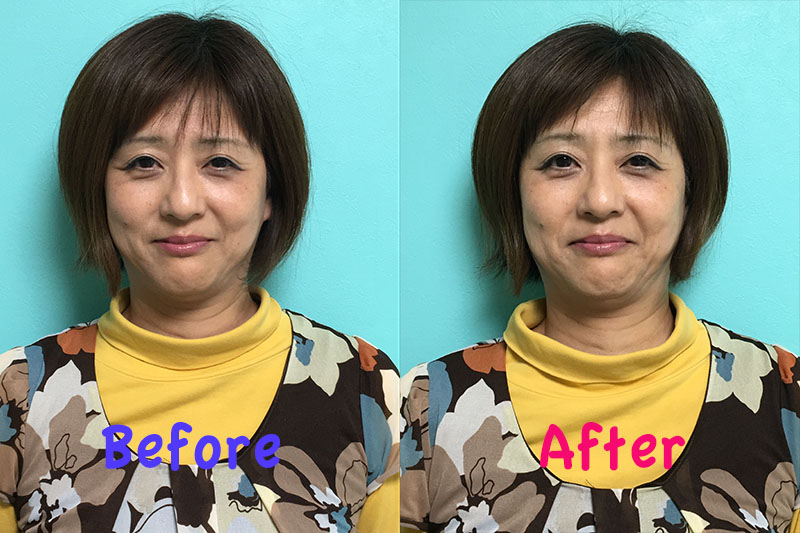 フェイスリフトBefore・After
