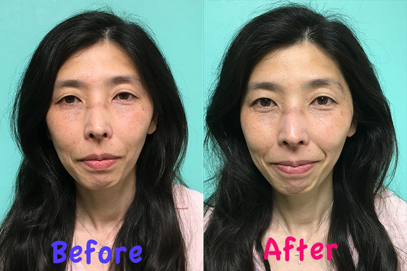 フェイスリフト新宮陽子さん